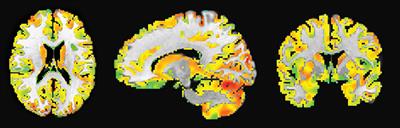 Multi-modal, Multi-measure, and Multi-class Discrimination of ADHD with Hierarchical Feature Extraction and Extreme Learning Machine Using Structural and Functional Brain MRI